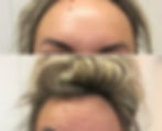 anti-wrinkle injections Chester