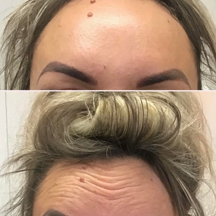 top angle of before and after results of anti-wrinkle injections provided by Samantha Pierce Aesthetics based in Chester.