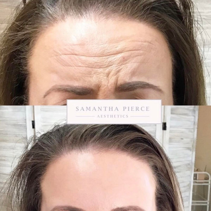 front angle of before and after results of anti-wrinkle injections provided by Samantha Pierce Aesthetics based in Chester.