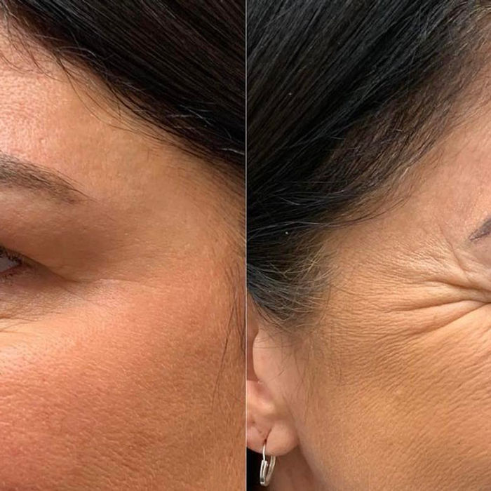 side angle of before and after results of anti-wrinkle injections provided by Samantha Pierce Aesthetics based in Chester.