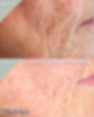 dermaforce rf microneedling results Chester