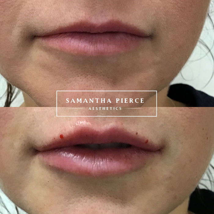 front angle of dermal filler before and after results provided at our aesthetics clinic based in Chester.