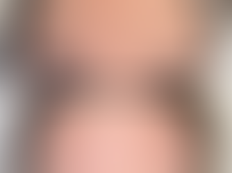 before and after results for upper face anti-wrinkle injections in Portsmouth