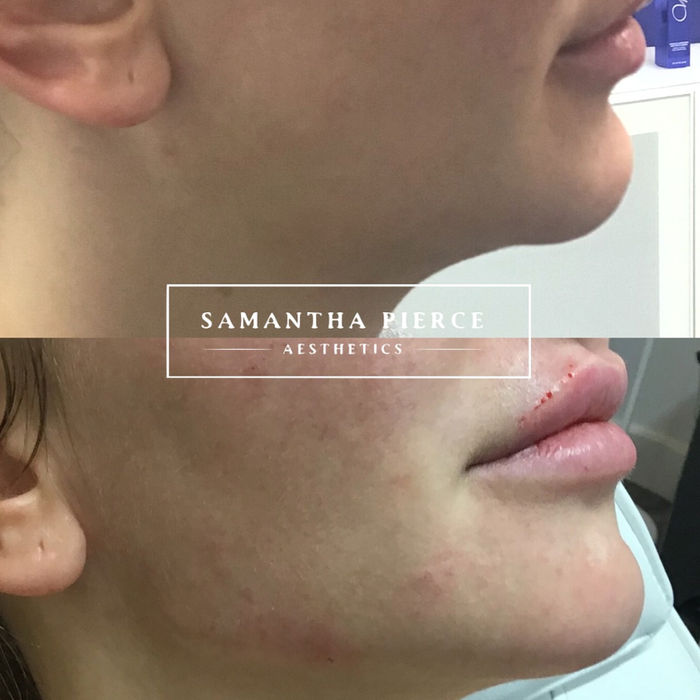 Side angle of dermal filler before and after results provided at our aesthetics clinic based in Chester.