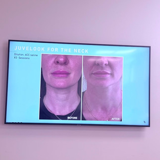 Juvelook and lenisna before and after results