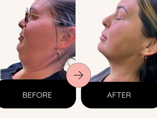 Fat dissolving injections results Stamford