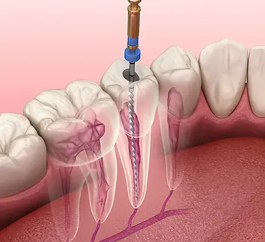 root-canal-treatment.webp