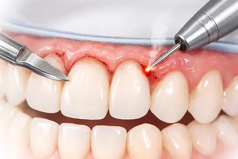 Gingivectomy & Gingivoplasty.webp