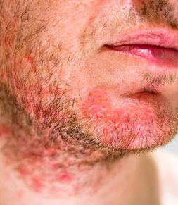 Pseudofoliculite de Barba