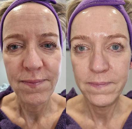 Facial-2.jpeg
