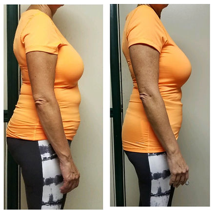 Abdomen-Side-no-logo-Before-After-6-2.jpeg
