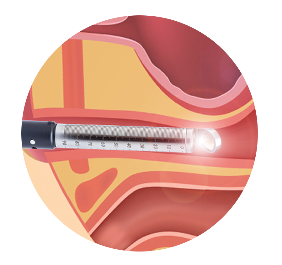 Laser vaginal