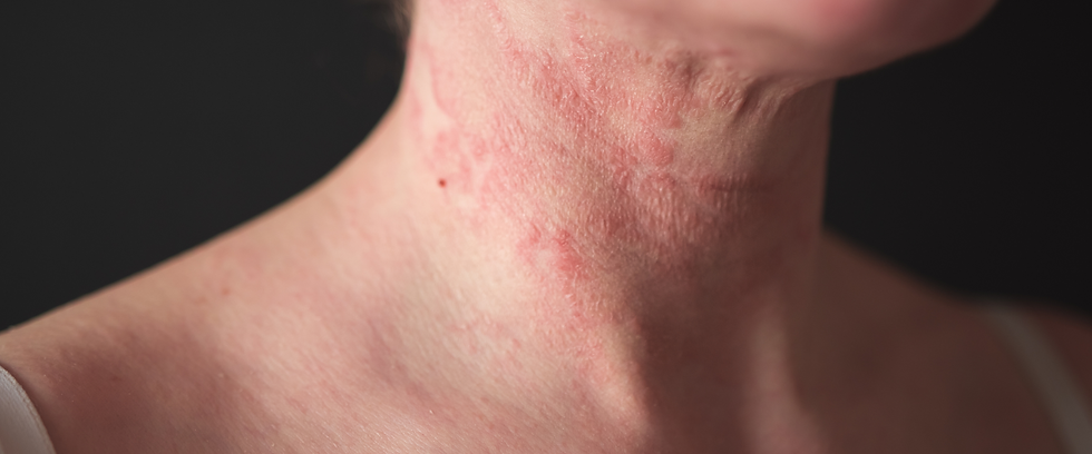 A women with eczema on her neck