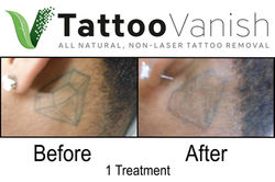 Best Tattoo Removal Van Nuys, Ca (9)