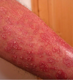 Pikkelysömör (psoriasis)