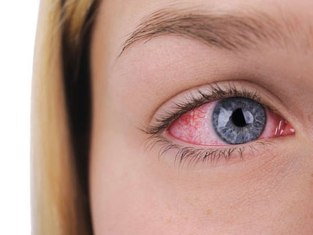 uveite lille, oeil rouge, oeil douloureux, vision trouble, vision floue