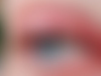 blépharite lille, meibomite lille, paupière gonflée, paupière irritée, enflammée, enflée