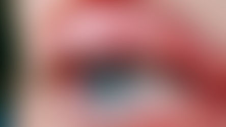 blépharite lille, meibomite lille, paupière gonflée, paupière irritée, enflammée, enflée