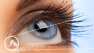 traitement du larmoiement par clous trous