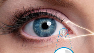 traitement de la sécheresse oculaire par bouchons