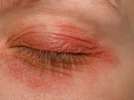 ophtalmologue à Lille spécialiste de l'eczéma des paupières