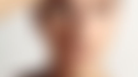 botox, photos avant apres botox, rides du front, rides du lion, rides de la patte d'oie