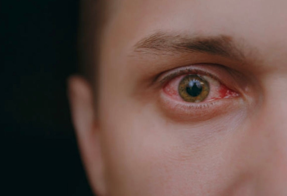 keratite à lille, oeil rouge, oeil douloureux, vision trouble, vision floue