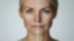 botox visage Lille