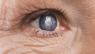 vision floue liée à une cataracte à Lille