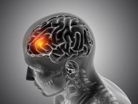 AVC DE L’ŒIL LILLE, AVC OCULAIRE, INFARCTUS OCULAIRE
