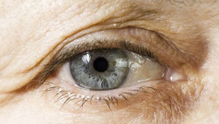 opération des paupières tombantes à Lille