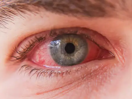 conjonctivite lille, oeil rouge, oeil gonflé, oeil collé