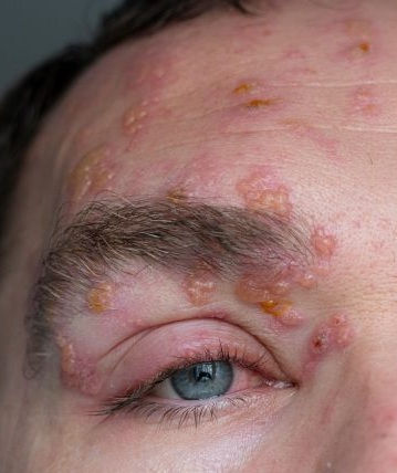 zona de l'oeil à Lille