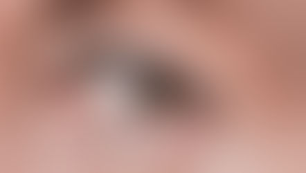 opération des paupières à Lille