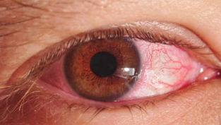 keratite lille, oeil rouge, oeil douloureux, vision trouble, vision floue