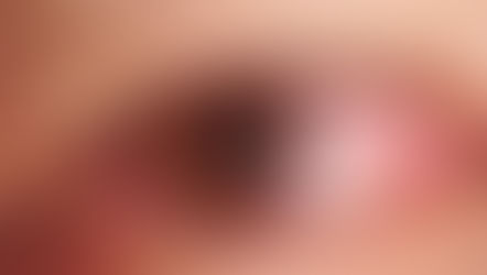 keratite lille, oeil rouge, oeil douloureux, vision trouble, vision floue