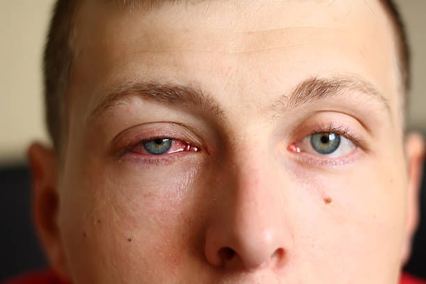 conjonctivite lille, oeil rouge, oeil gonflé, oeil collé, oeil qui coule qui colle