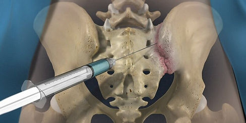 Sacroiliac_Joint_Injection.jpeg