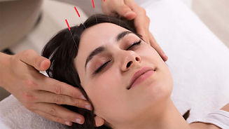 Acupuntura-para-Enxaqueca-e-Dor-de-Cabeca-1.jpg
