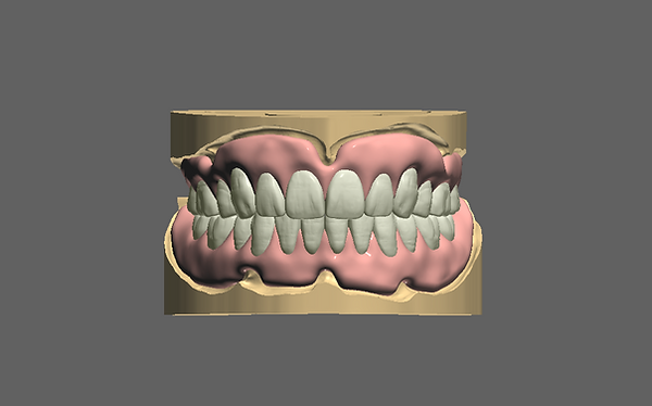 Les prothèses numériques