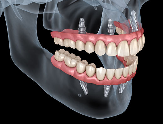 Une prothèse sur implants
