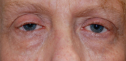 upper and Lower blepharoplasty1 CEL.jpg