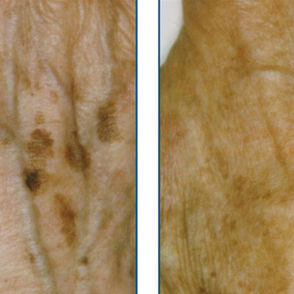 EXCELIGHT---PIGMENTATION-2---The-Lynton-Clinic-