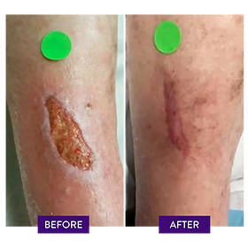 置物 the wound does not heal What to Do When a Wound Just Won't Heal | University of Utah Health