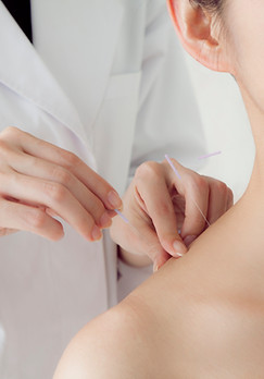 Acupuncture Session