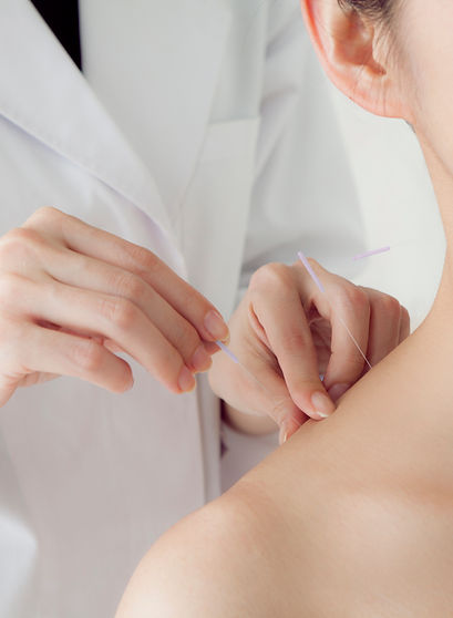 doctor applying acupuncture needles to a woman