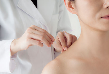 Doctor puttin acupuncture needle in woman