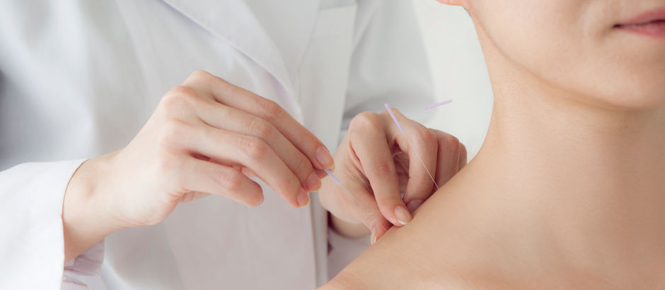 Trigger Point Needling