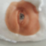 Orbital Prosthesis by Andrea Kozma