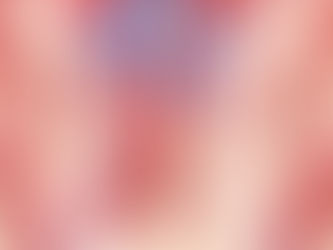 Seaver–Cassidy Syndrome